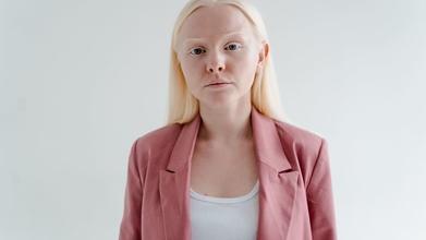 Casting hombres y mujeres albinos para proyecto en Buenos Aires